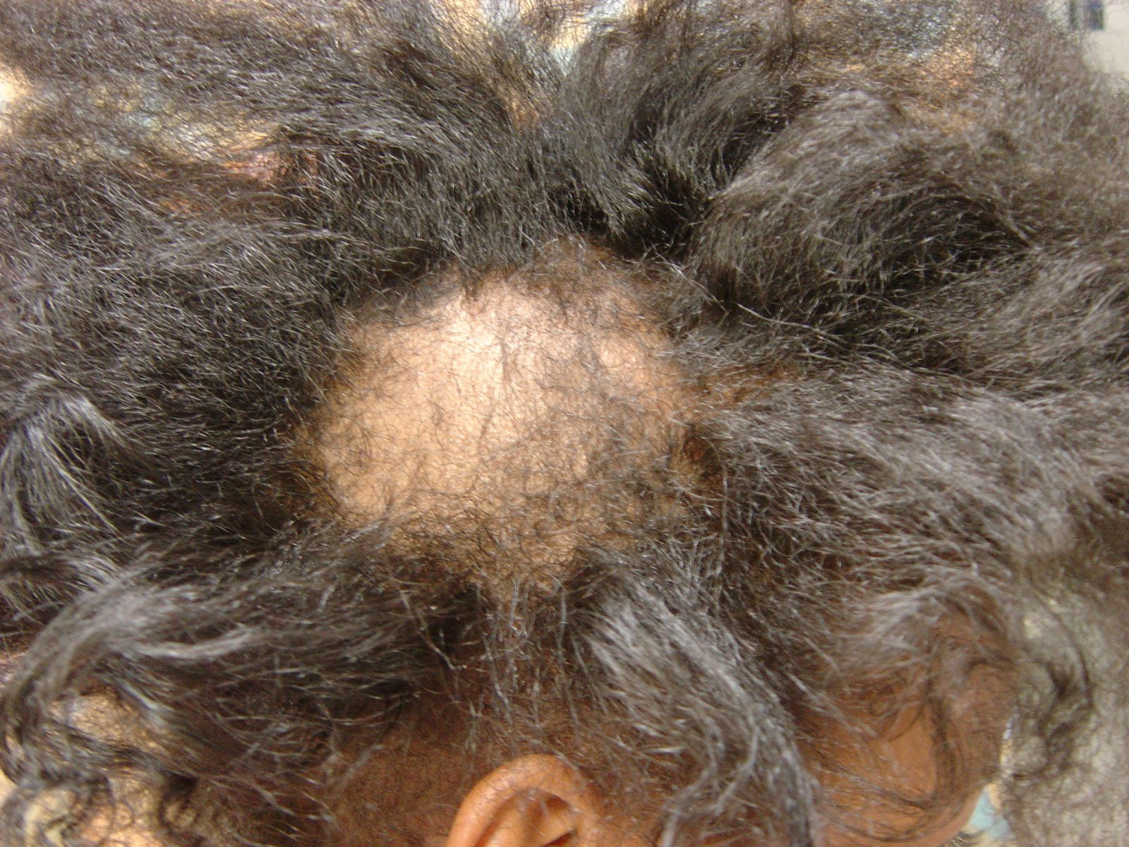 Hair Pulling Disorder In Children
 Trichotillomania Visual Diagnosis