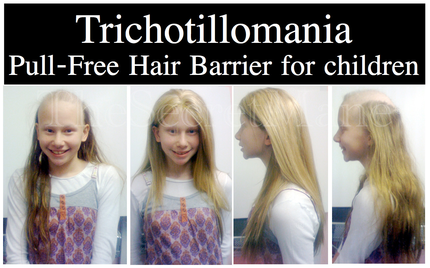 Hair Pulling Disorder In Children
 Childhood Trichotillomania Treatment Before and After