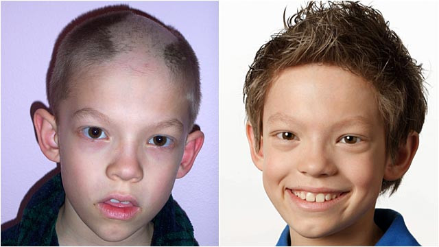 Hair Pulling Disorder In Children
 Iowa Boy Who Pulled Out His Hair Gets Help With Hair