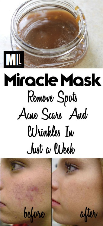 DIY Acne Scar Mask
 Miracle Face Mask to Get Rid of Spots Acne Scars and