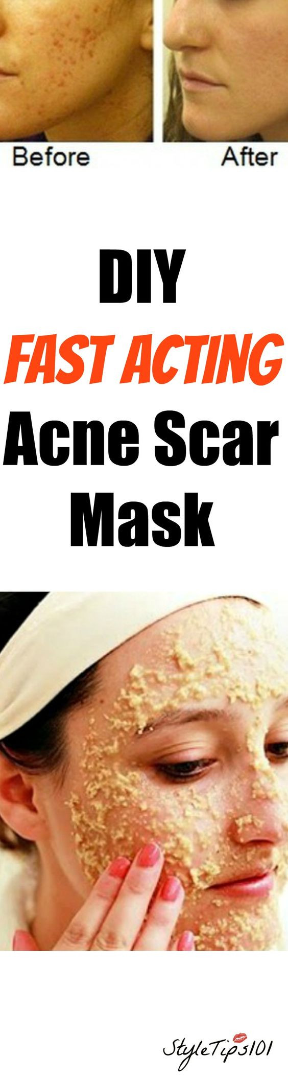 DIY Acne Scar Mask
 DIY Acne Scar Mask