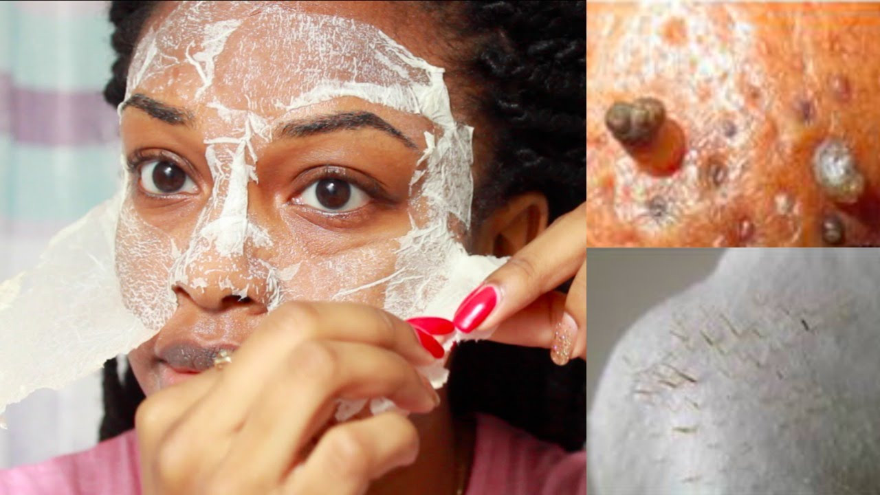 DIY Peel Off Mask For Acne
 EASY DIY Egg Blackhead Remover Peel f Mask