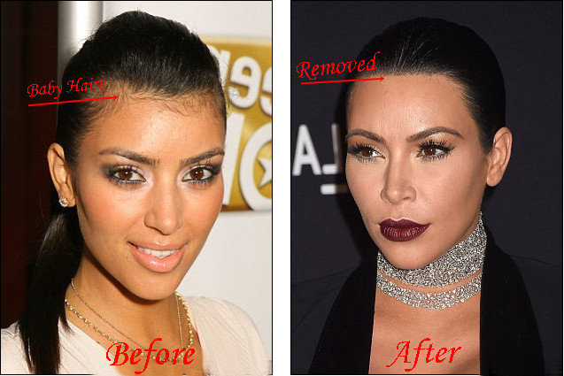 Laser Hair Removal Baby Hair
 Kim Kardashian Laser Hair Removal Before And After