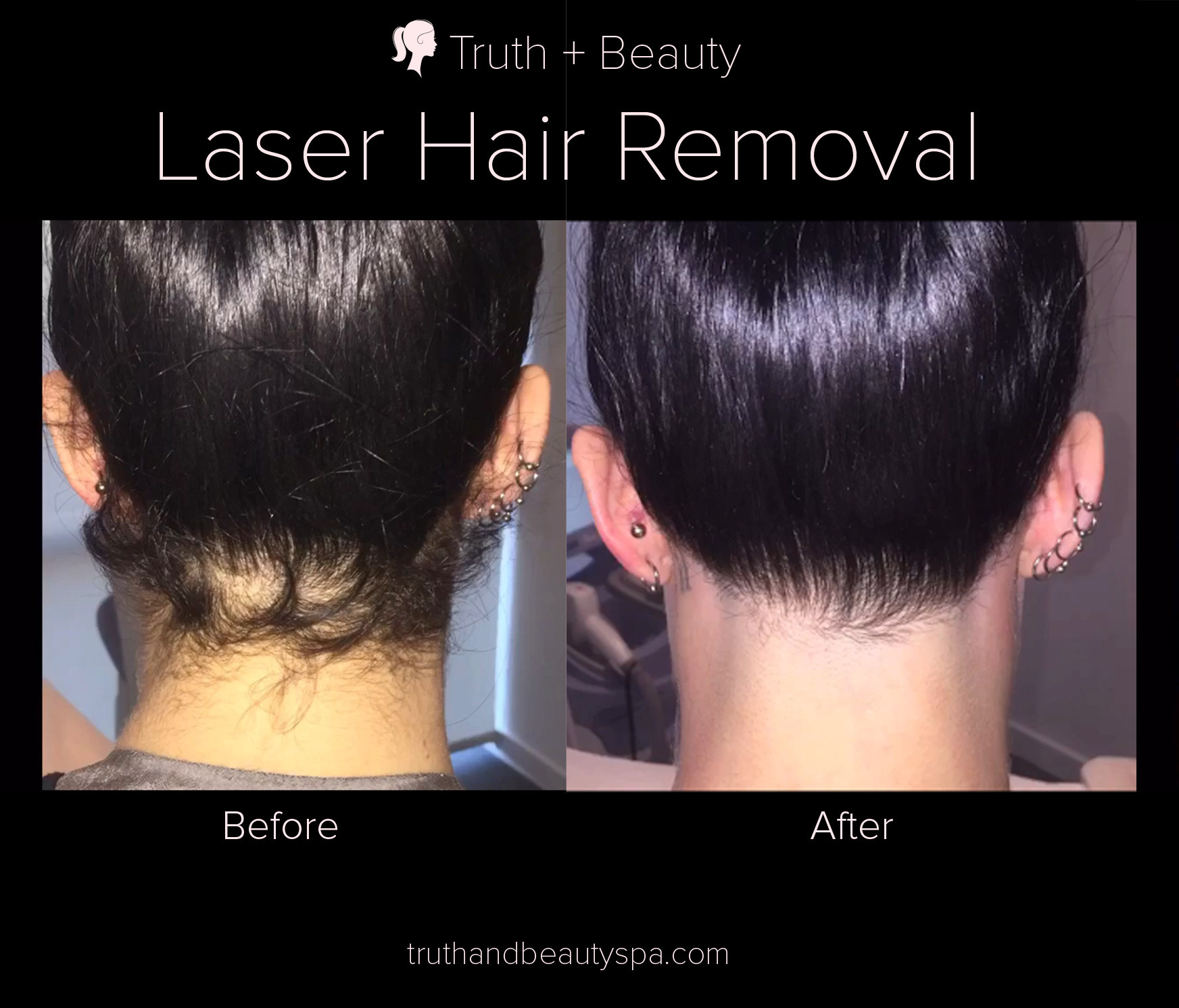 Laser Hair Removal Baby Hair
 Laser Hair Reduction in New York Truth Beauty Spa