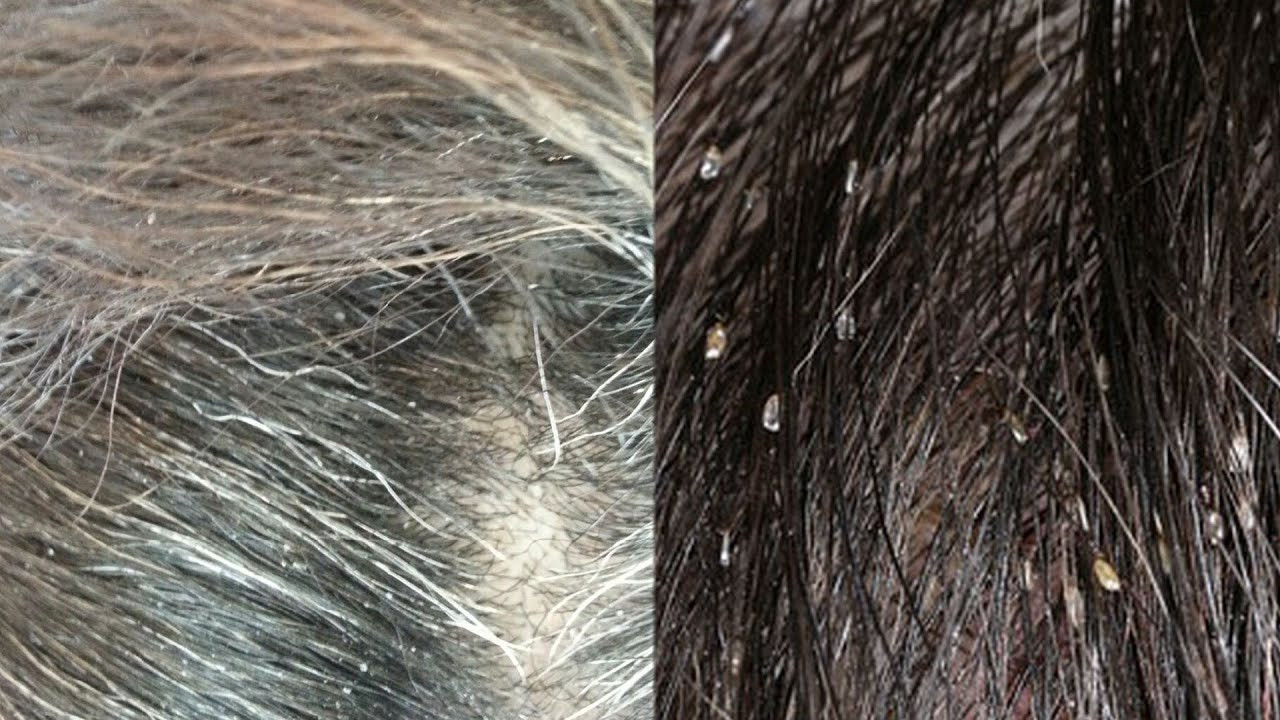 Lice In Kids' Hair Pictures
 Head lice or Dandruff Ask The Expert 310 874 4550