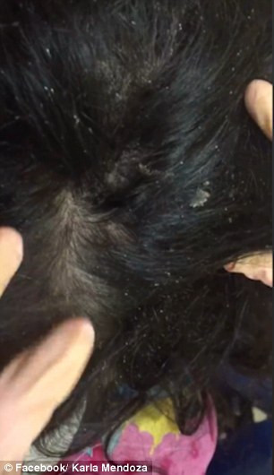 Lice In Kids' Hair Pictures
 Is this the worst case of head lice EVER Mother posts