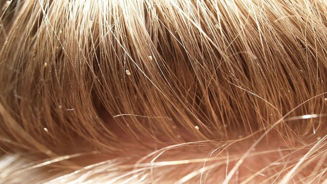 Lice In Kids' Hair Pictures
 Getting Rid of Head Lice Treatment Options Chemist 4 U