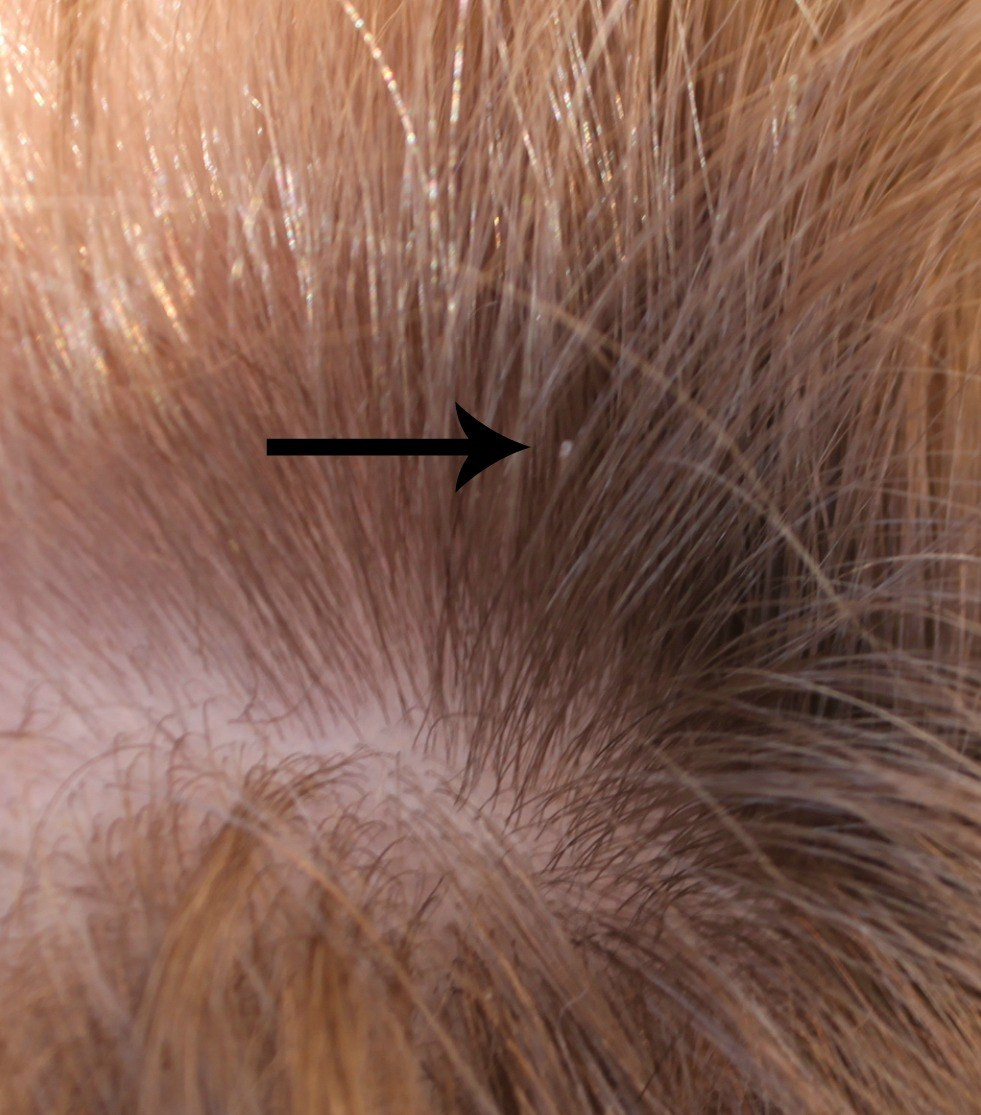 Lice In Kids' Hair Pictures
 to rid of lice