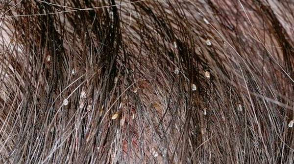 Lice In Kids' Hair Pictures
 Head Lice Are Extremely Contagious