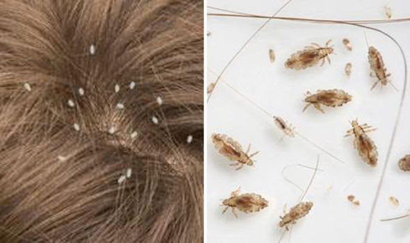 Lice In Kids' Hair Pictures
 Warning over mutant head lice that are IMMUNE to lotions