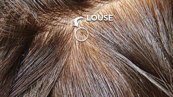 Lice In Kids' Hair Pictures
 What Do Lice Look Like The Video Is Kinda Gross But Necessary