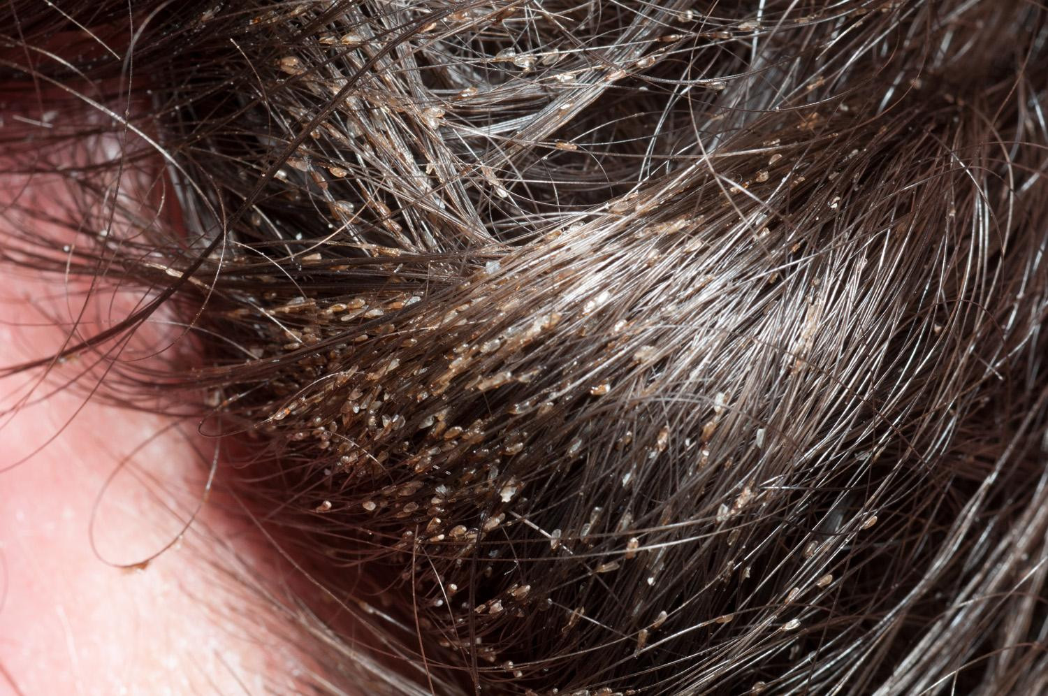 Lice In Kids' Hair Pictures
 What lice beneath
